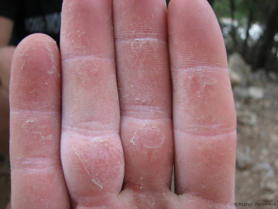 Prsti po tri dnevnem plezanju
